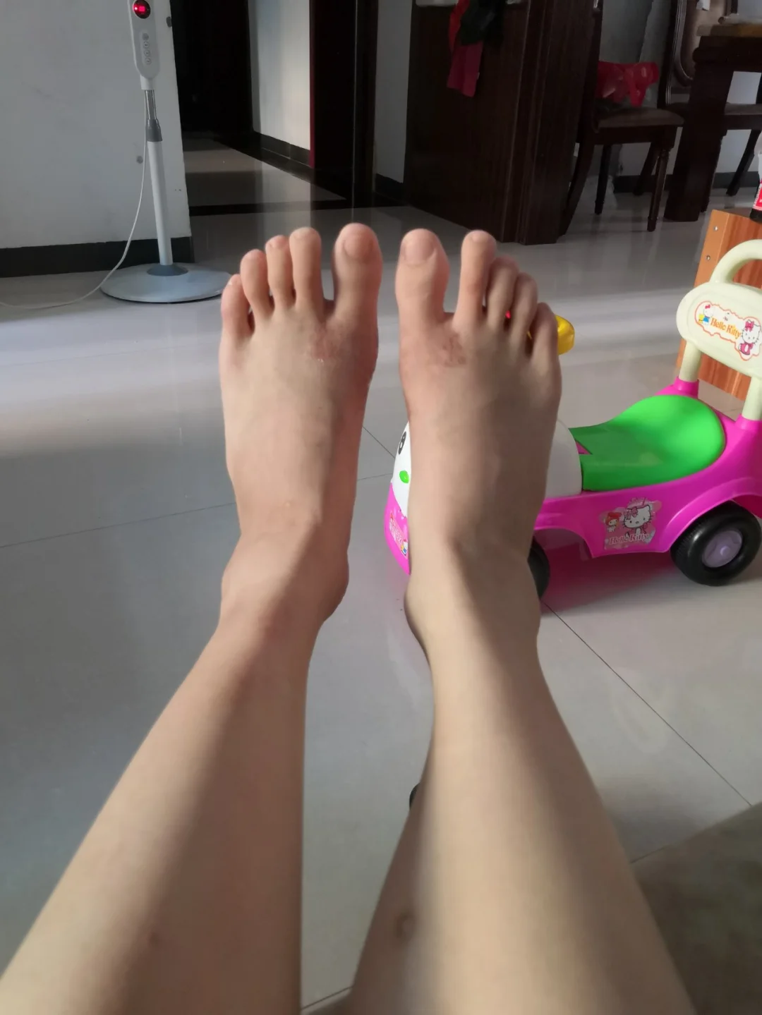 JJJ正式接受脚趾手术三个月后重新评估(切掉一个脚趾的手术)